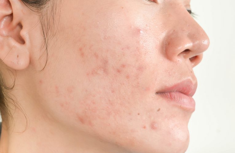 Espinhas, as famosas acnes: o que causa e como tratar