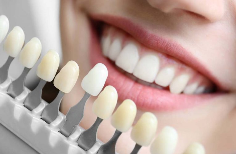 Lente de contato dental evolui e procedimentos odontológicos ficam menos invasivos