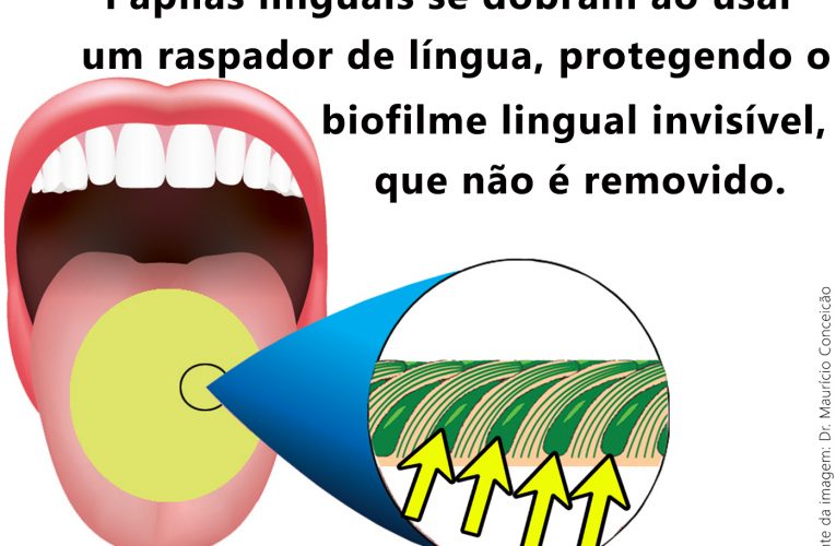 Técnica químico-mecânica de limpeza da língua combate a boca amarga, mau hálito e cáseos amigdalianos com uma maior eficácia, revela pesquisa