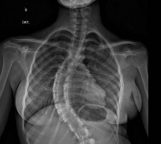 Segundo a OMS, escoliose pode afetar 2% a 4% da população mundial