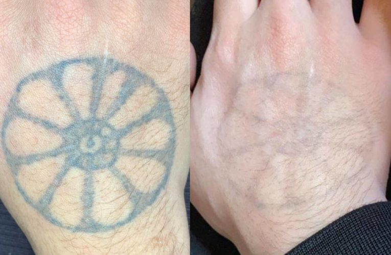 Especialista esclarece dúvidas sobre remoção de tatuagem