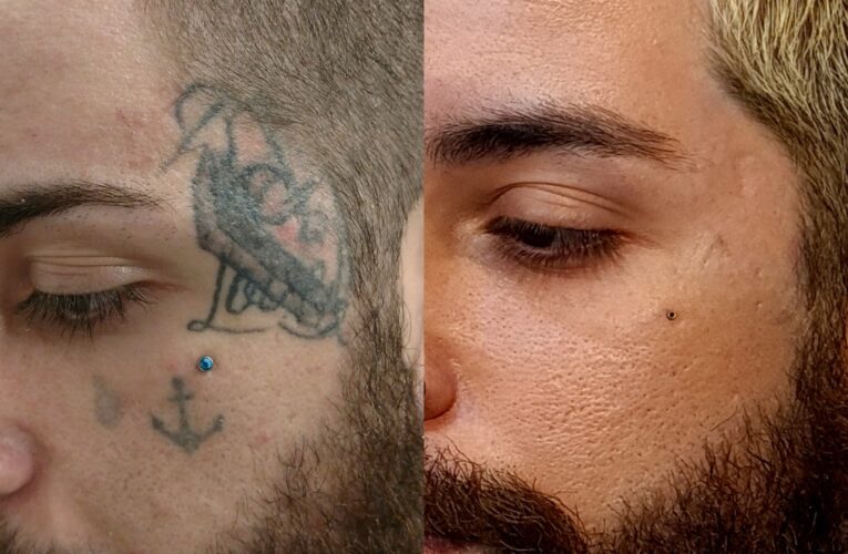 Especialista fala sobre cuidados para a remoção de tatuagens