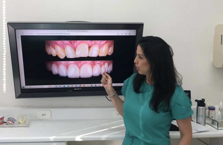 Cirurgiã dentista explica as diferenças entre lentes de resina e de porcelana