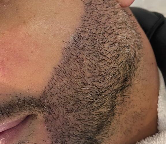 Transplante de barba cresce no mercado masculino